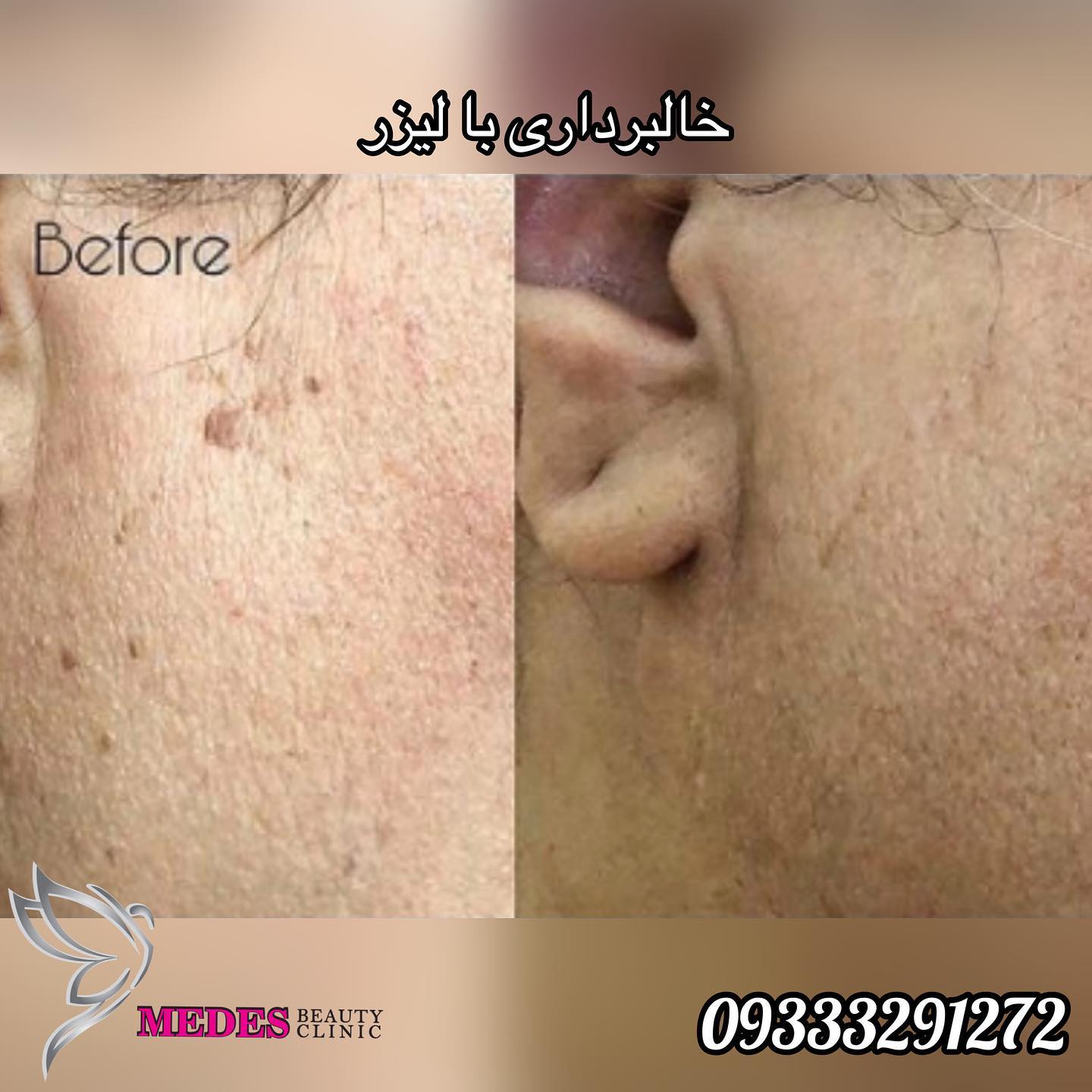 برداشت خال و زگیل